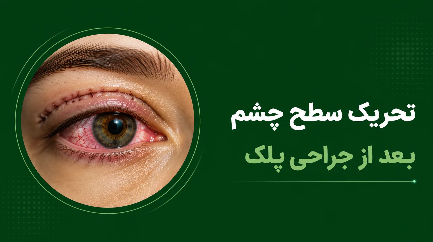 تحریک سطح چشم بعد از جراحی پلک